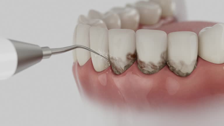 Trusted Wisdom Tooth Removal service in Walnut, CA - Dentist Open Now